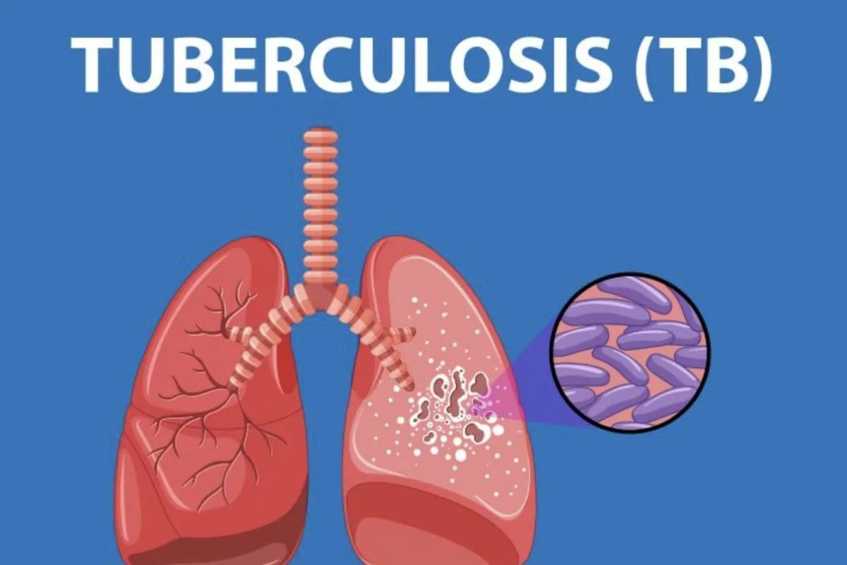 WHO Tetapkan Tuberkulosis Penyakit Menular Paling Mematikan, Ini 5 Cara Pencegahannya